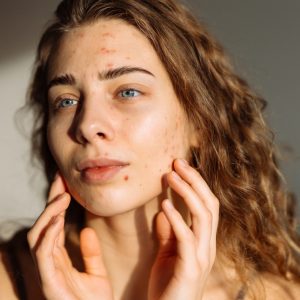 Ani Akne Artışıyla Mücadelede Kaçınılması Gereken Kritik Hatalar Nelerdir