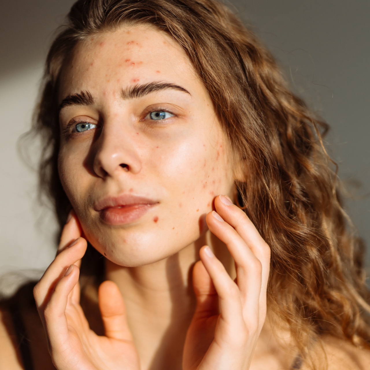 Ani Akne Artışıyla Mücadelede Kaçınılması Gereken Kritik Hatalar Nelerdir