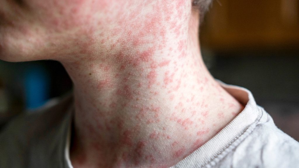 Çocukluk Hastalığı Geri Döndü mü? Kızamık Vakalarındaki Tehlikeli Artış!