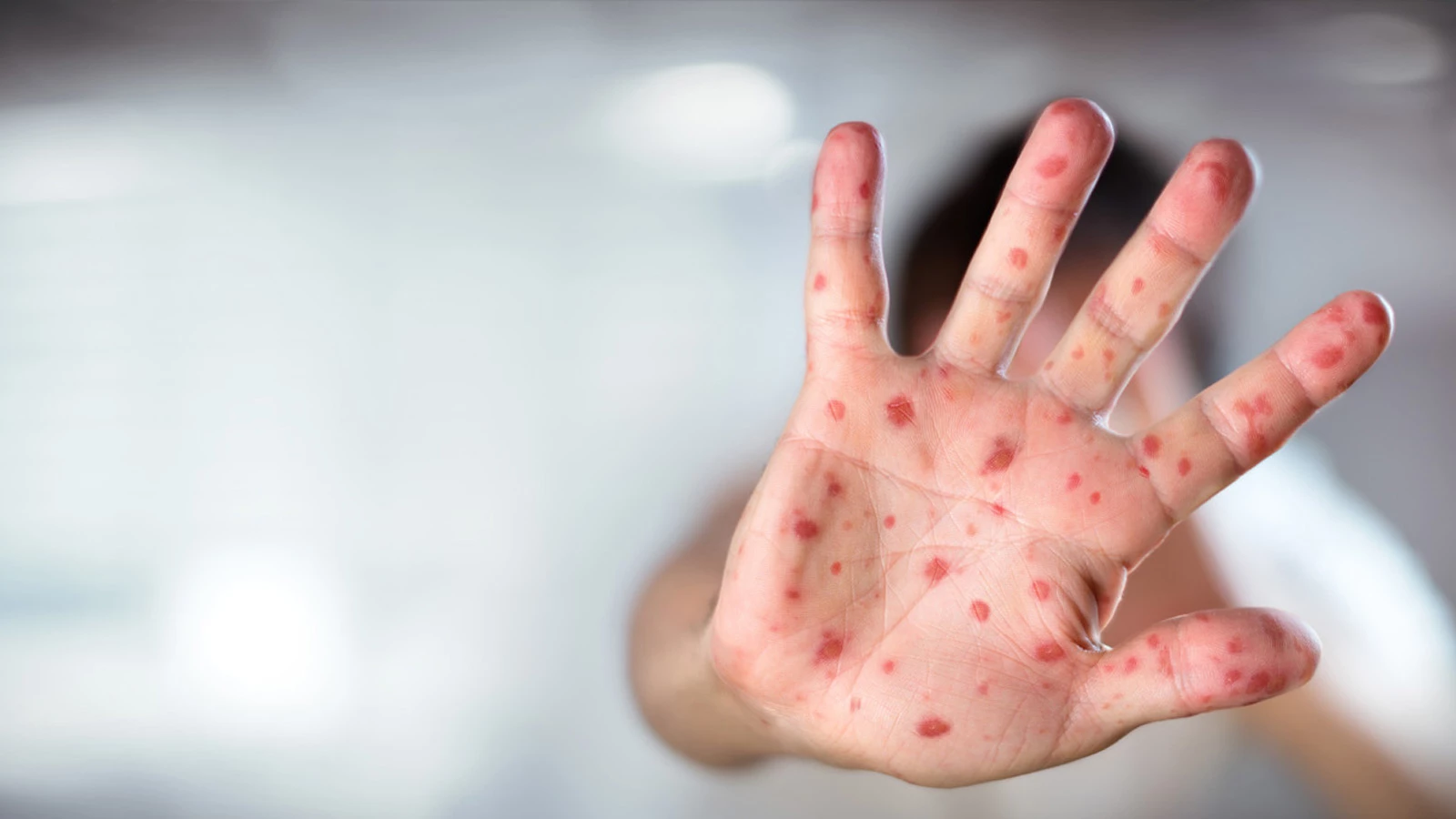 Kızamık salgını hızla yayılırken aşılanmanın önemi artıyor