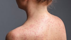 Kızamık Tehlikesi: Uzmanlar Uyarıyor, Aşı İhmal Edilmemeli!