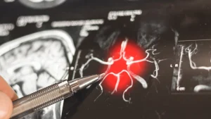 Bilim insanları Alzheimer’ın hafıza kaybı öncesi gizli evresini haritalandırdı