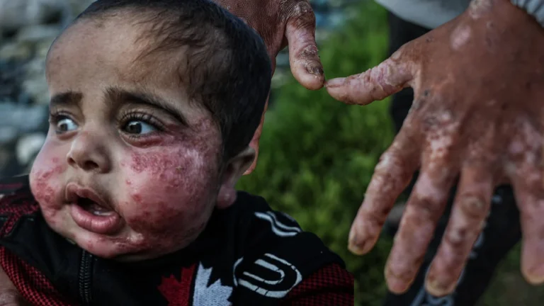 Suriye’nin Rakka kentinde artan şark çıbanı vakaları bölge halkını tehdit ediyor