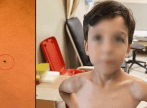 7 yaşındaki çocuğun göğsünden kene çıkarıldı