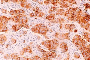 Kanser tedavisinde yeni umut: Otoantikor proteinler